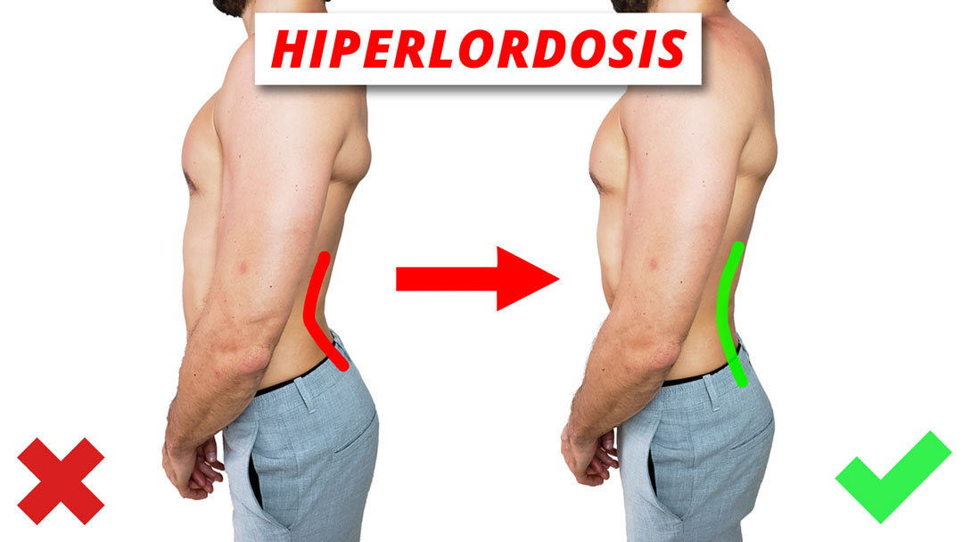 Hiperlordosis lumbar
