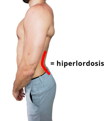 la hiperlordosis lumbar